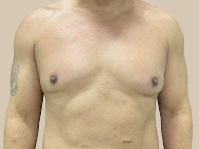 Gynecomastia Before & After Gallery - Patient 182909 - Image 1