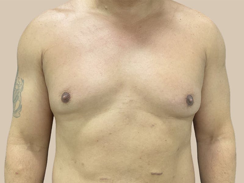 Gynecomastia Before & After Gallery - Patient 182909 - Image 1