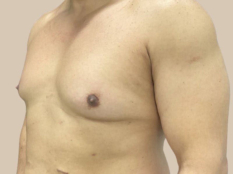 Gynecomastia Before & After Gallery - Patient 182909 - Image 5