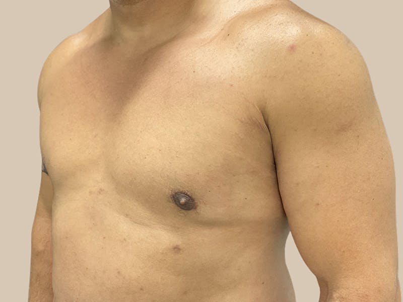 Gynecomastia Before & After Gallery - Patient 182909 - Image 6