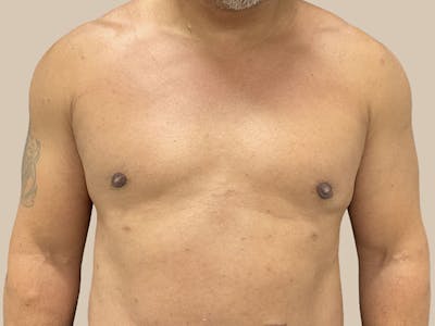 Gynecomastia Before & After Gallery - Patient 182909 - Image 2