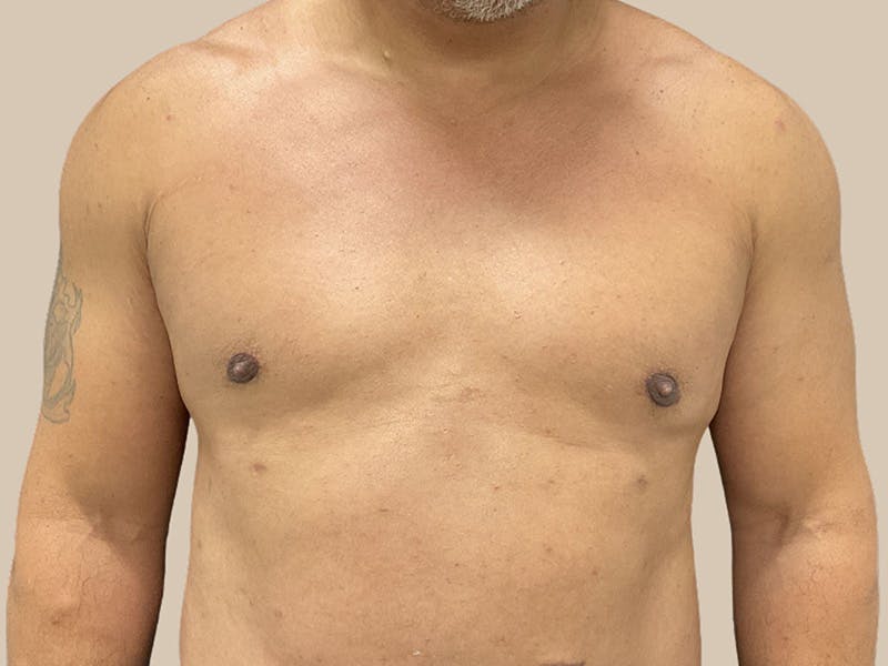 Gynecomastia Before & After Gallery - Patient 182909 - Image 2