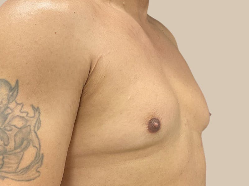 Gynecomastia Before & After Gallery - Patient 182909 - Image 3