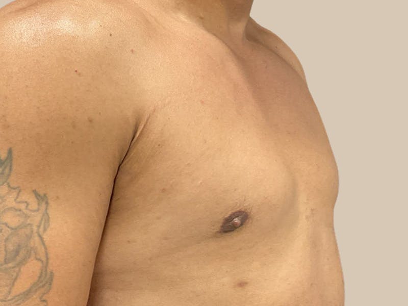 Gynecomastia Before & After Gallery - Patient 182909 - Image 4