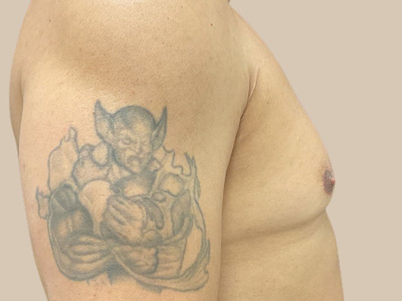 Gynecomastia Before & After Gallery - Patient 182909 - Image 7