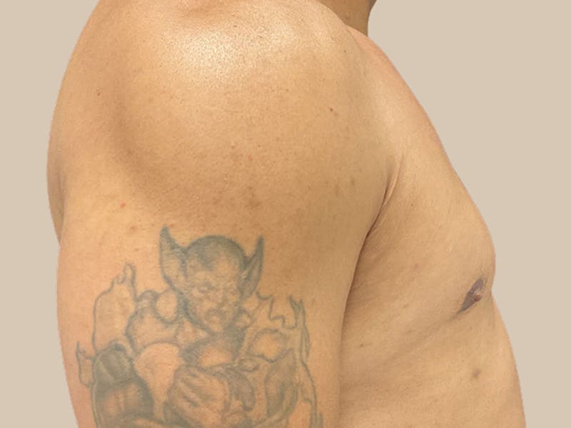 Gynecomastia Before & After Gallery - Patient 182909 - Image 8