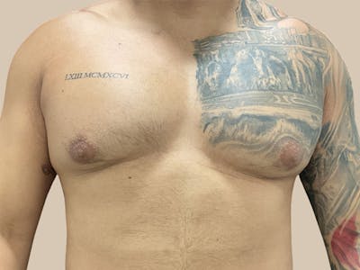 Gynecomastia Before & After Gallery - Patient 736816 - Image 1