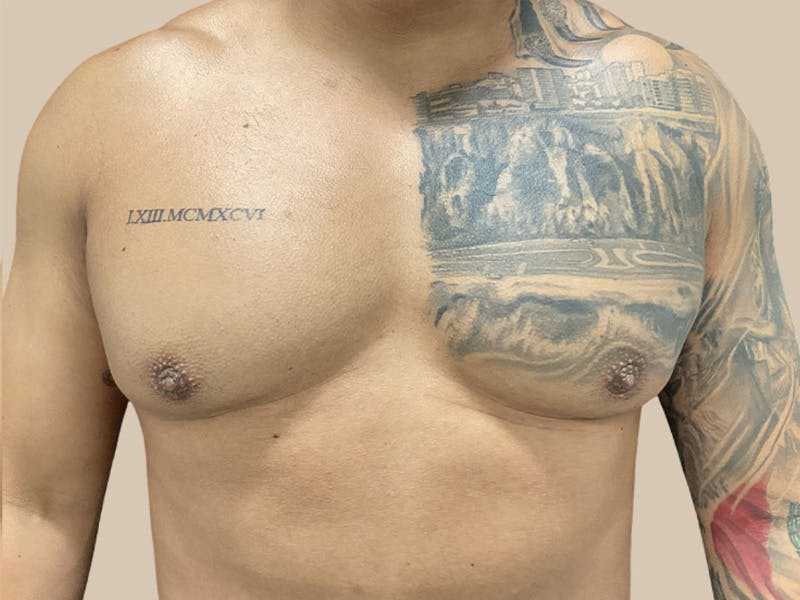 Gynecomastia Before & After Gallery - Patient 736816 - Image 2