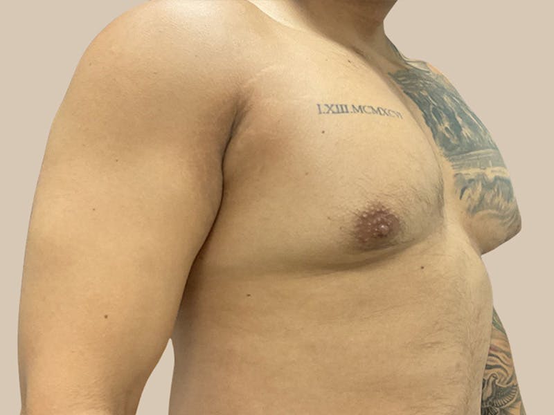 Gynecomastia Before & After Gallery - Patient 736816 - Image 3