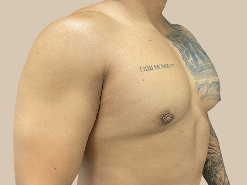 Gynecomastia Before & After Gallery - Patient 736816 - Image 4