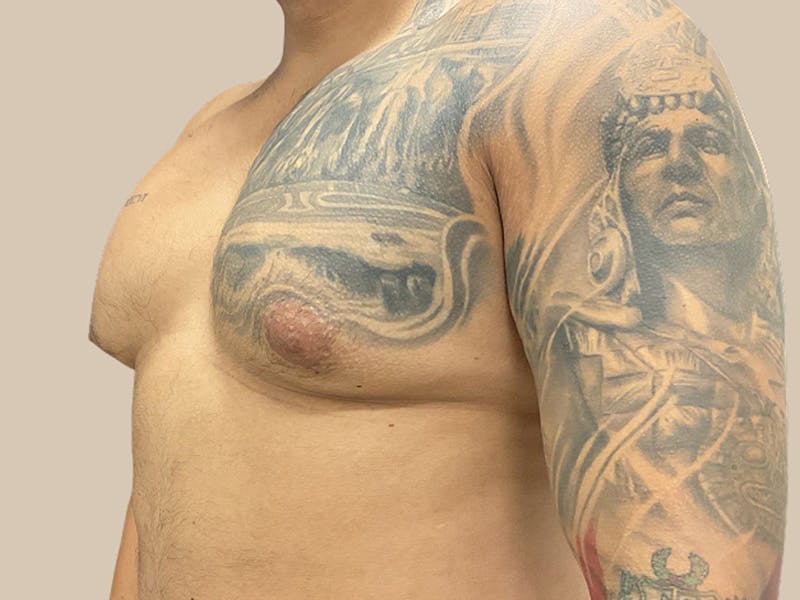 Gynecomastia Before & After Gallery - Patient 736816 - Image 5