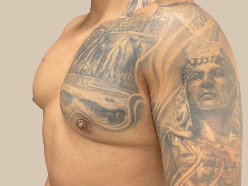 Gynecomastia Before & After Gallery - Patient 736816 - Image 6