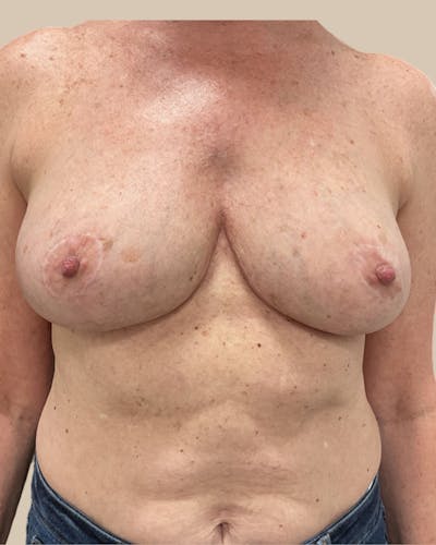 Breast Revision Before & After Gallery - Patient 150723 - Image 2