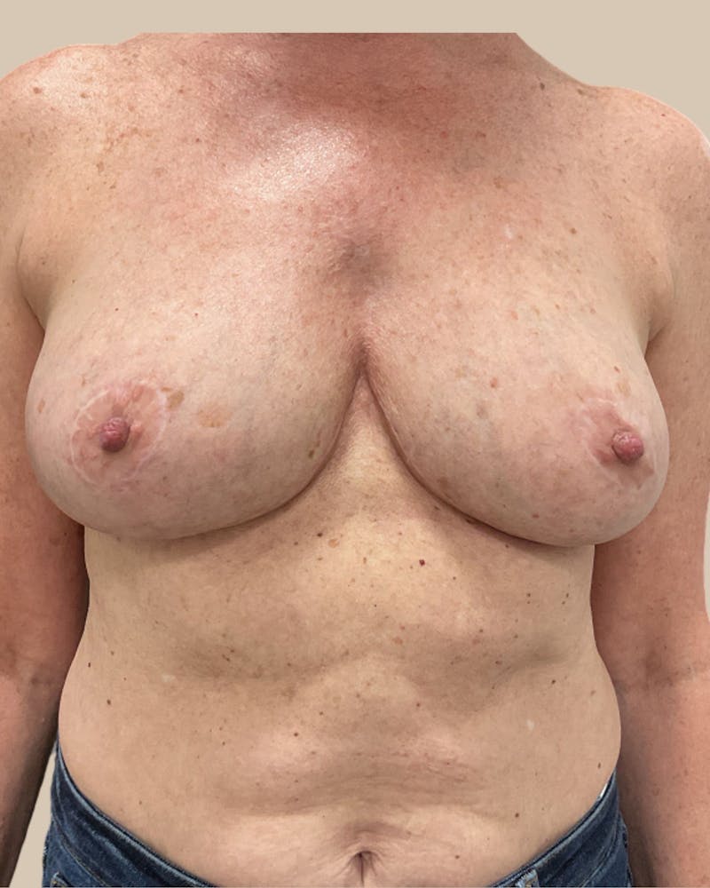 Breast Revision Before & After Gallery - Patient 150723 - Image 2