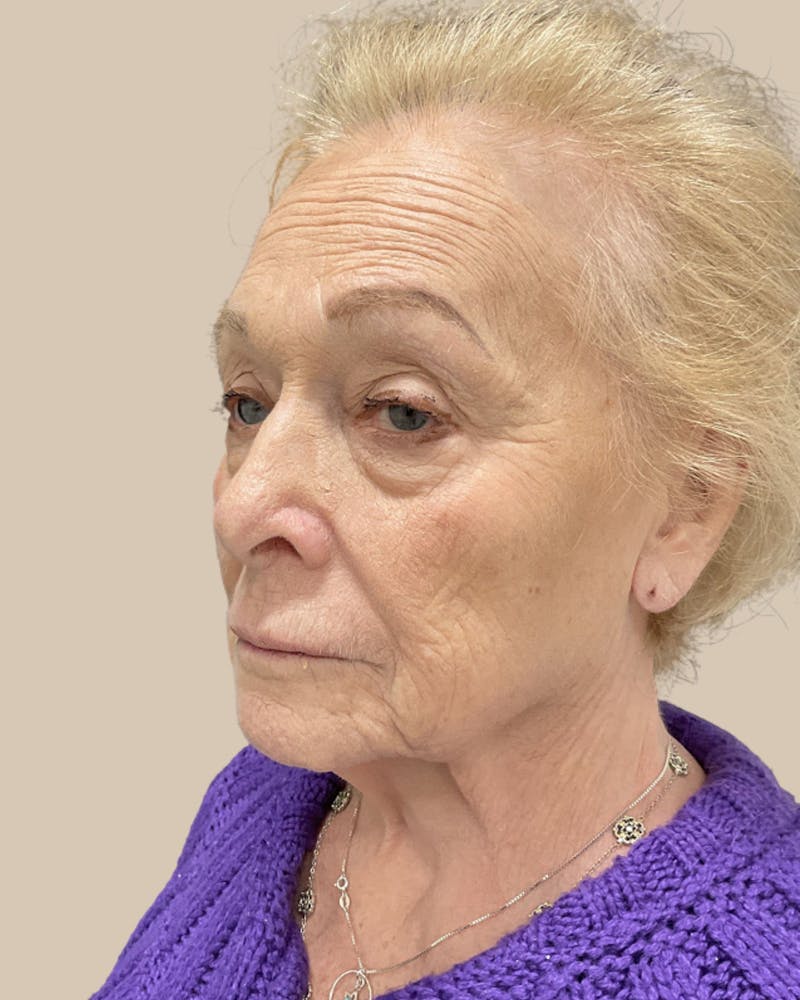 Facelift Before & After Gallery - Patient 136191 - Image 5