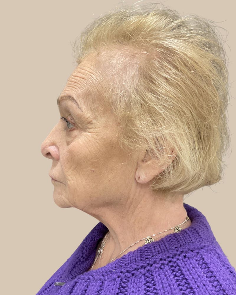 Facelift Before & After Gallery - Patient 136191 - Image 7
