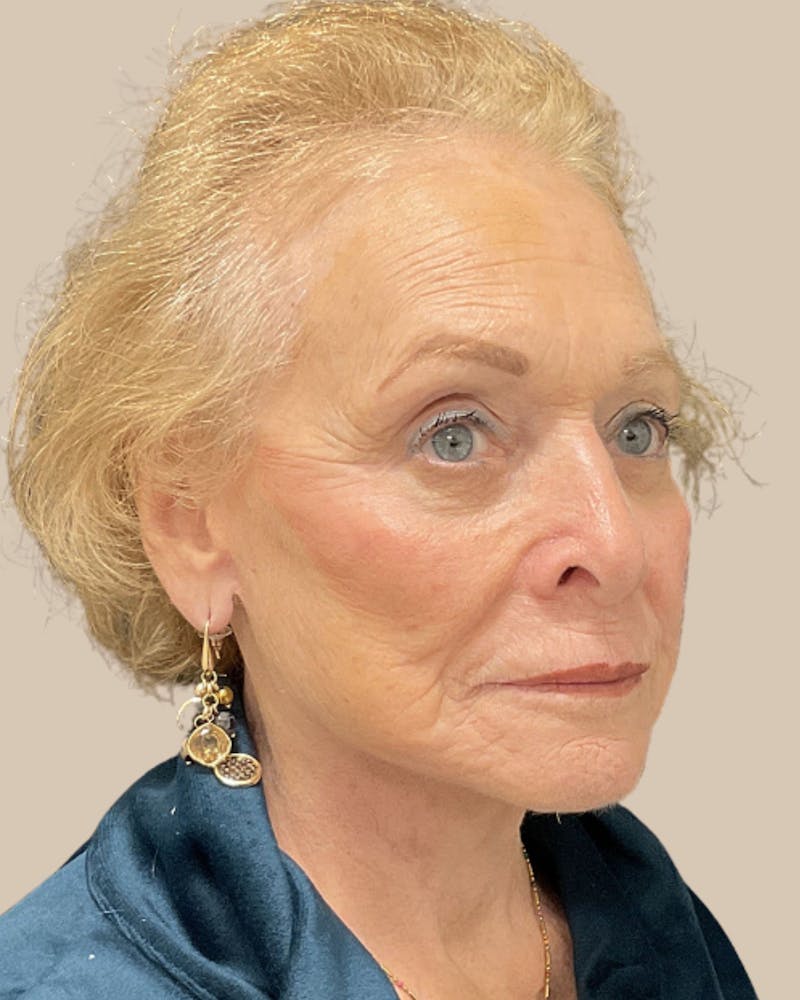 Facelift Before & After Gallery - Patient 136191 - Image 4