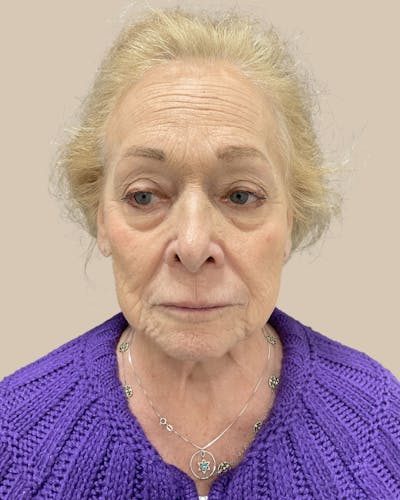 Facelift Before & After Gallery - Patient 136191 - Image 1