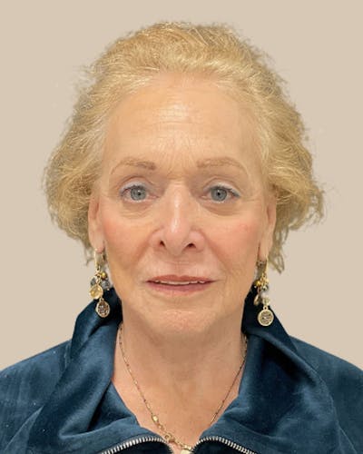 Facelift Before & After Gallery - Patient 136191 - Image 2