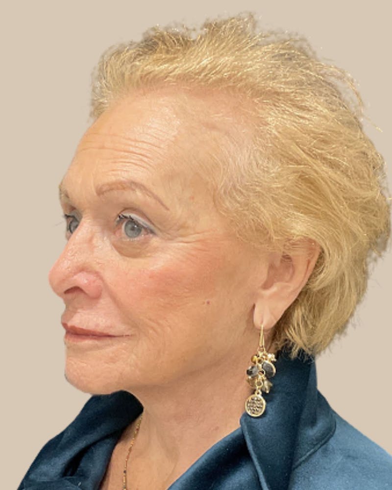 Facelift Before & After Gallery - Patient 136191 - Image 6