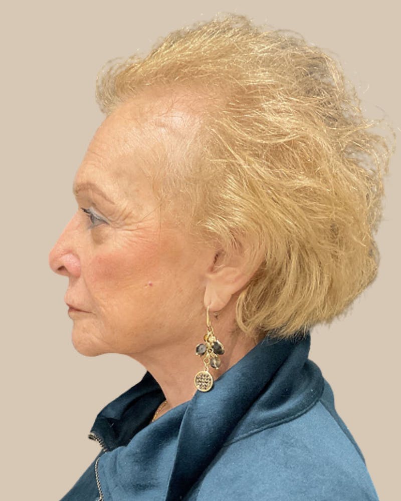Facelift Before & After Gallery - Patient 136191 - Image 8