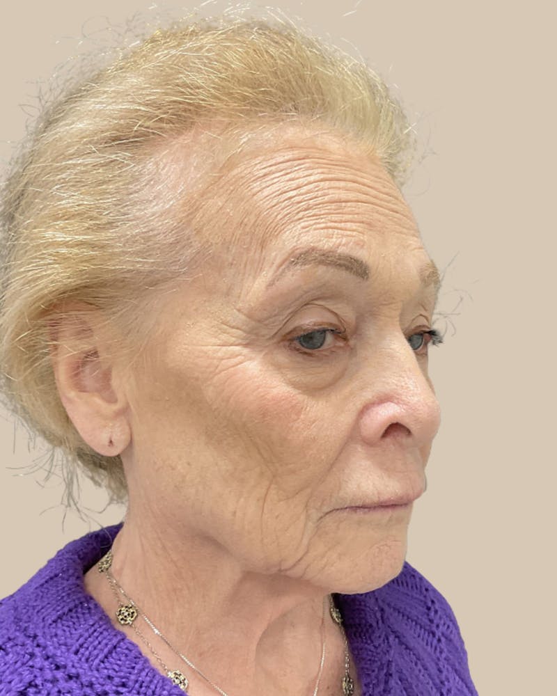 Facelift Before & After Gallery - Patient 136191 - Image 3