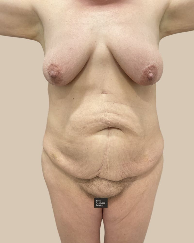 Trunkplasty Before & After Gallery - Patient 268539 - Image 1