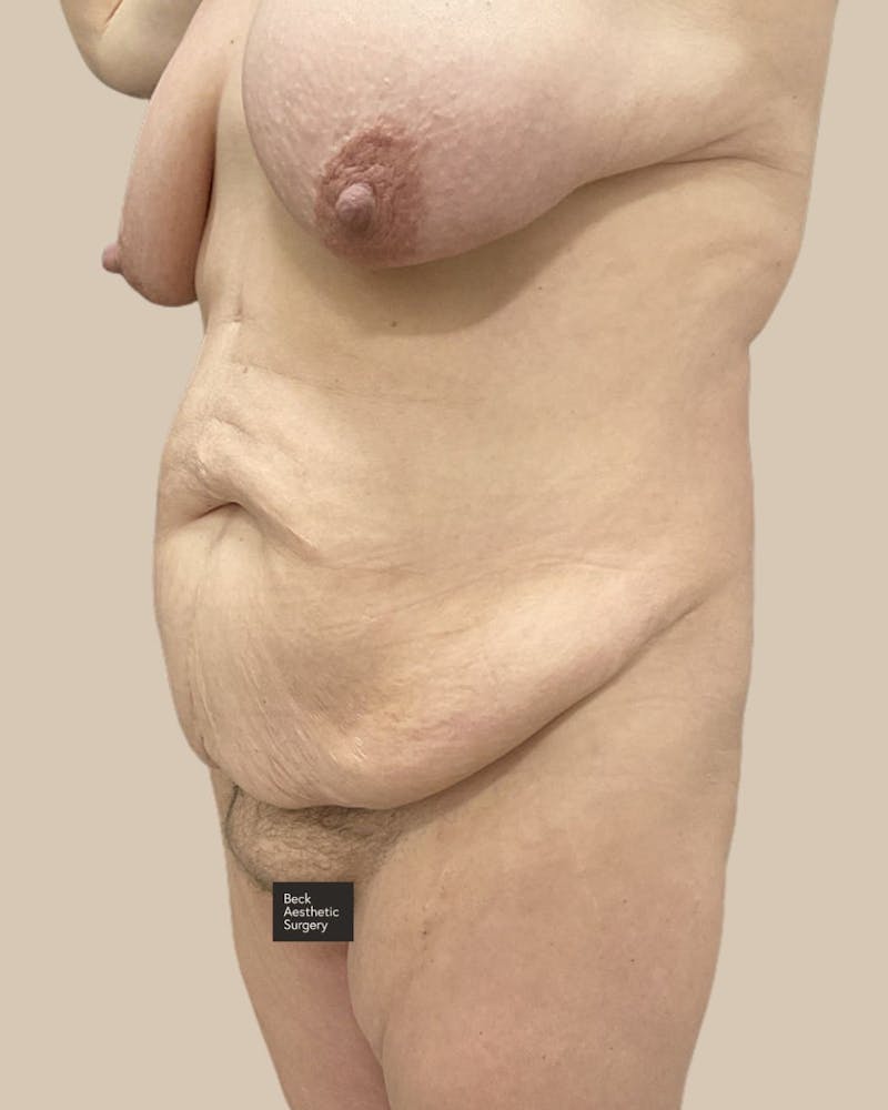 Trunkplasty Before & After Gallery - Patient 268539 - Image 5