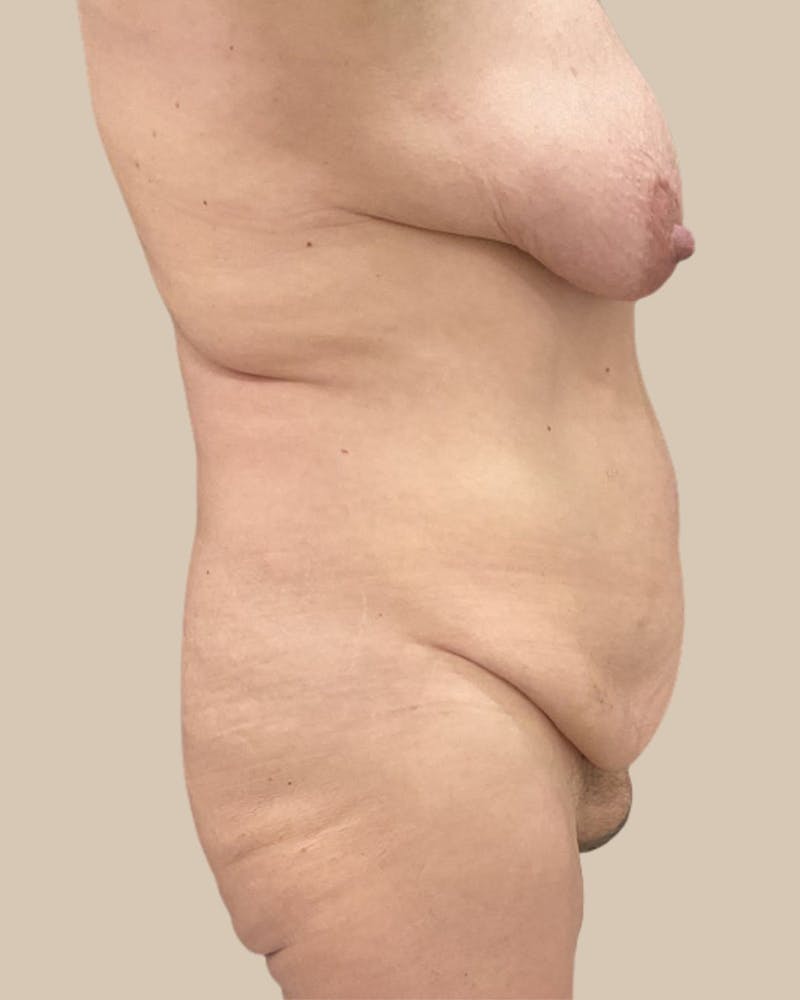 Trunkplasty Before & After Gallery - Patient 268539 - Image 7