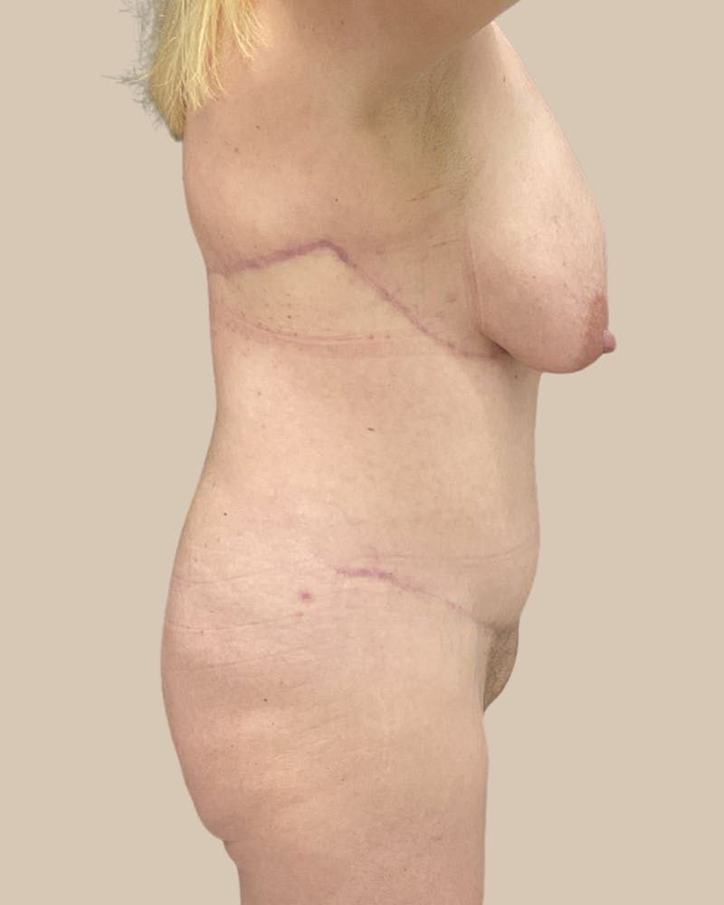 Trunkplasty Before & After Gallery - Patient 268539 - Image 8