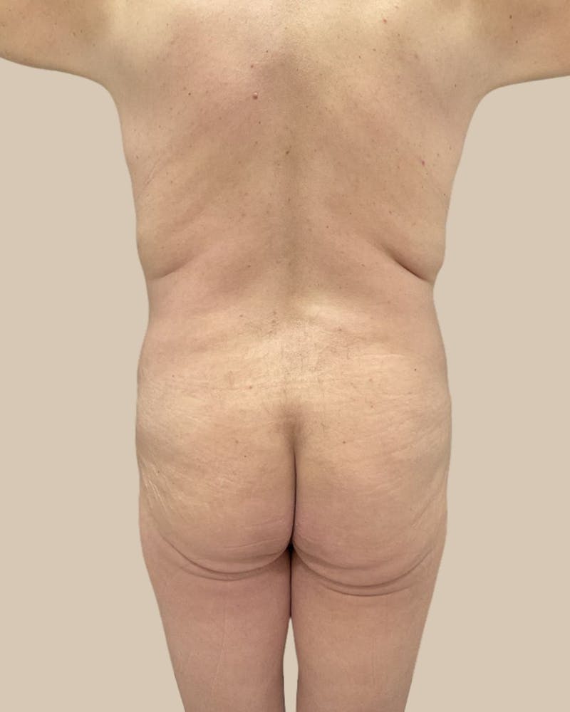 Trunkplasty Before & After Gallery - Patient 268539 - Image 9