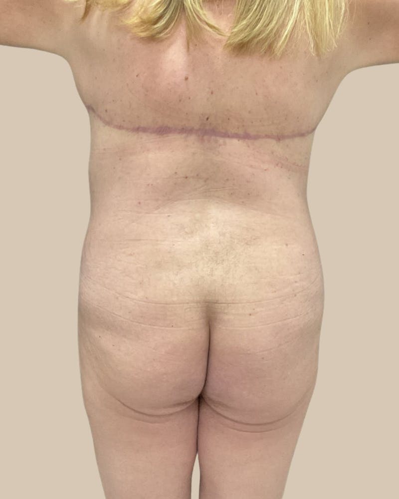 Trunkplasty Before & After Gallery - Patient 268539 - Image 10