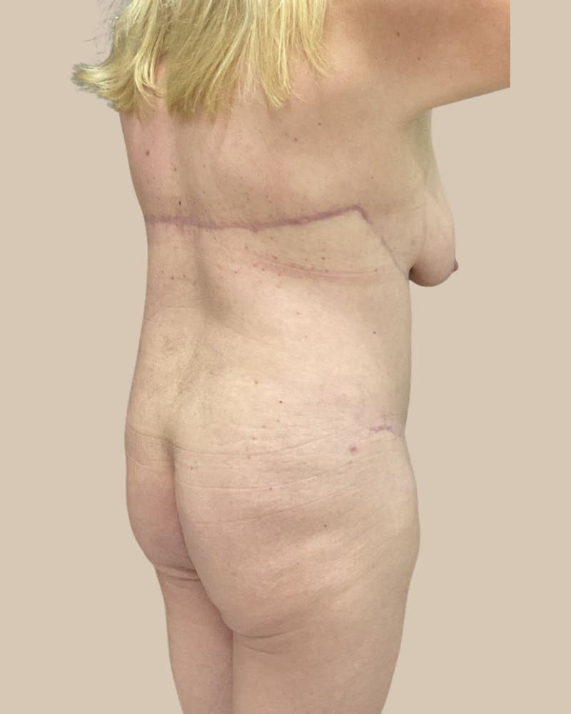 Trunkplasty Before & After Gallery - Patient 268539 - Image 14