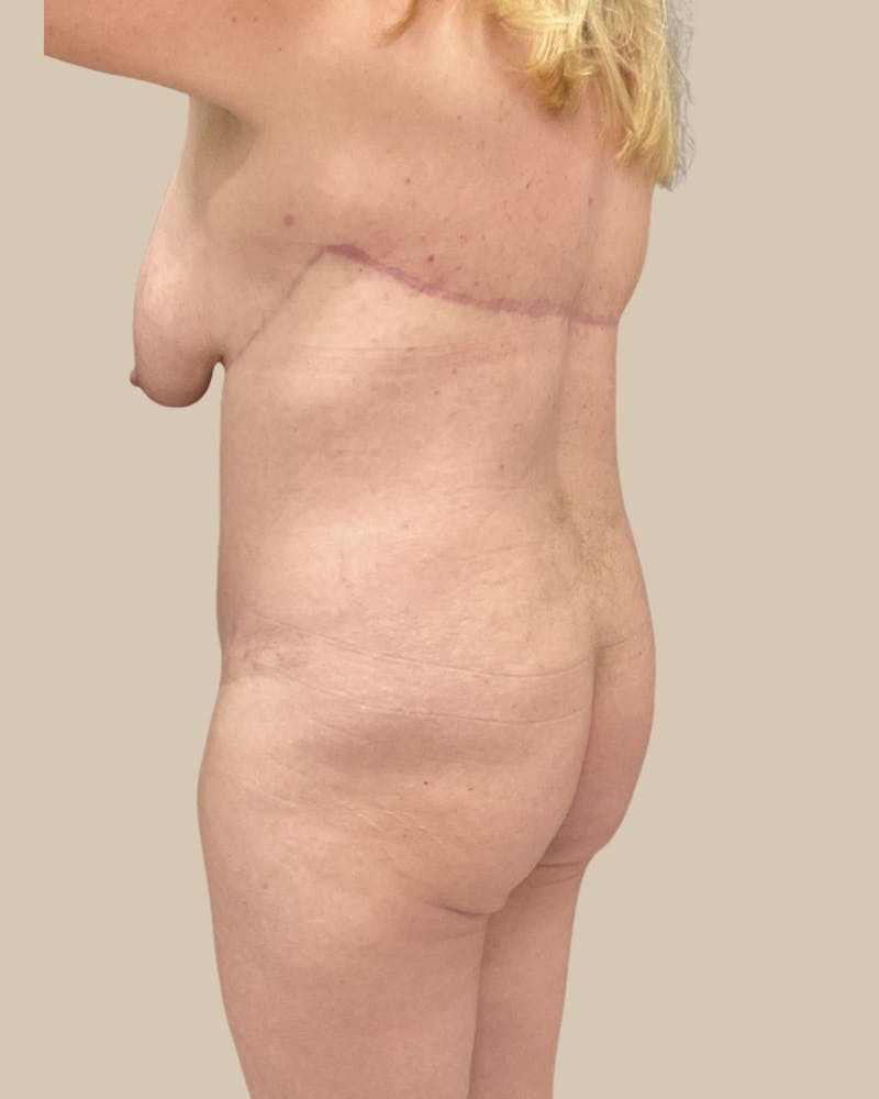 Trunkplasty Before & After Gallery - Patient 268539 - Image 12