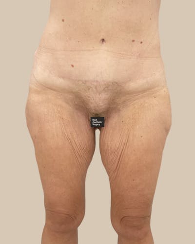Liposuction Before & After Gallery - Patient 410516 - Image 1