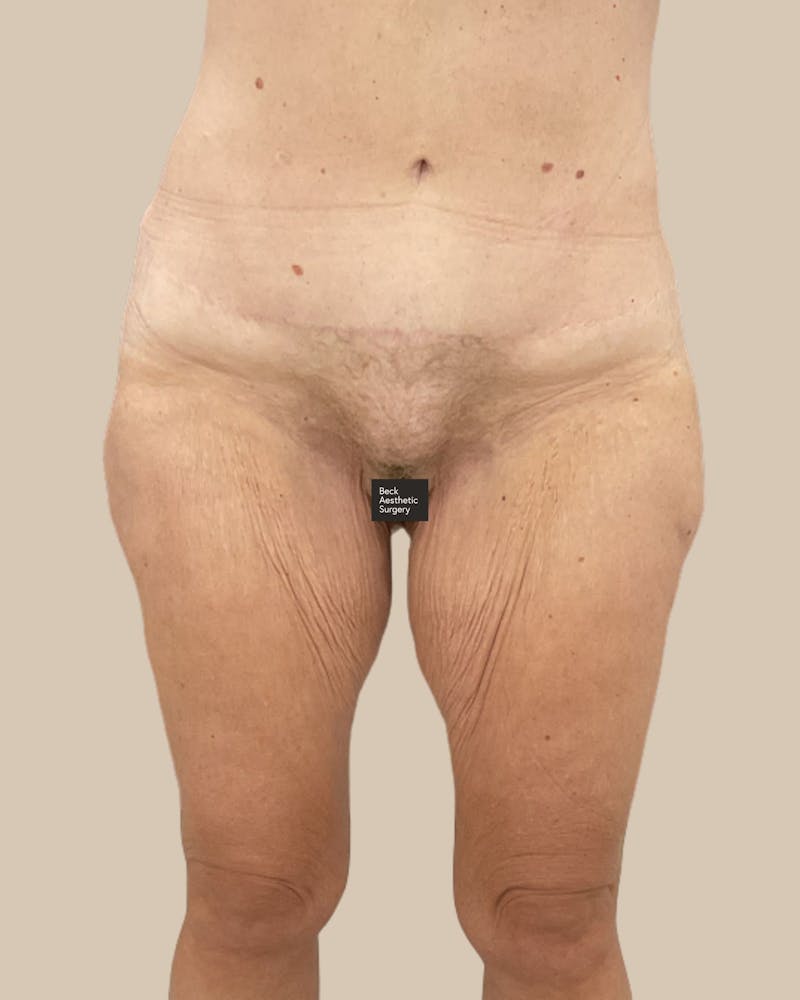 Liposuction Before & After Gallery - Patient 410516 - Image 1