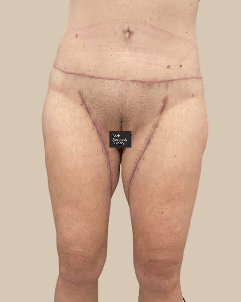 Liposuction Before & After Gallery - Patient 410516 - Image 2