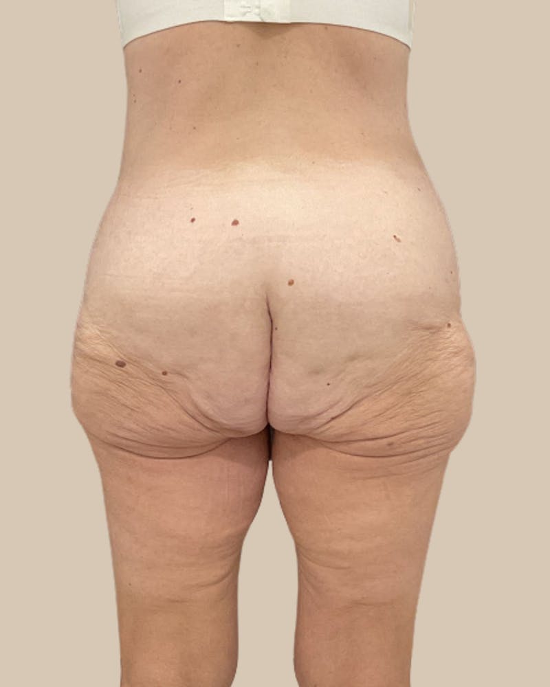 Liposuction Before & After Gallery - Patient 410516 - Image 5