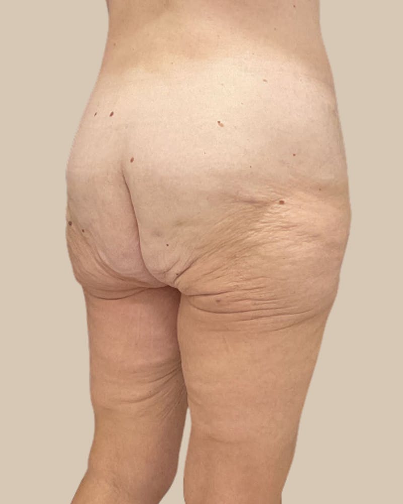 Liposuction Before & After Gallery - Patient 410516 - Image 3