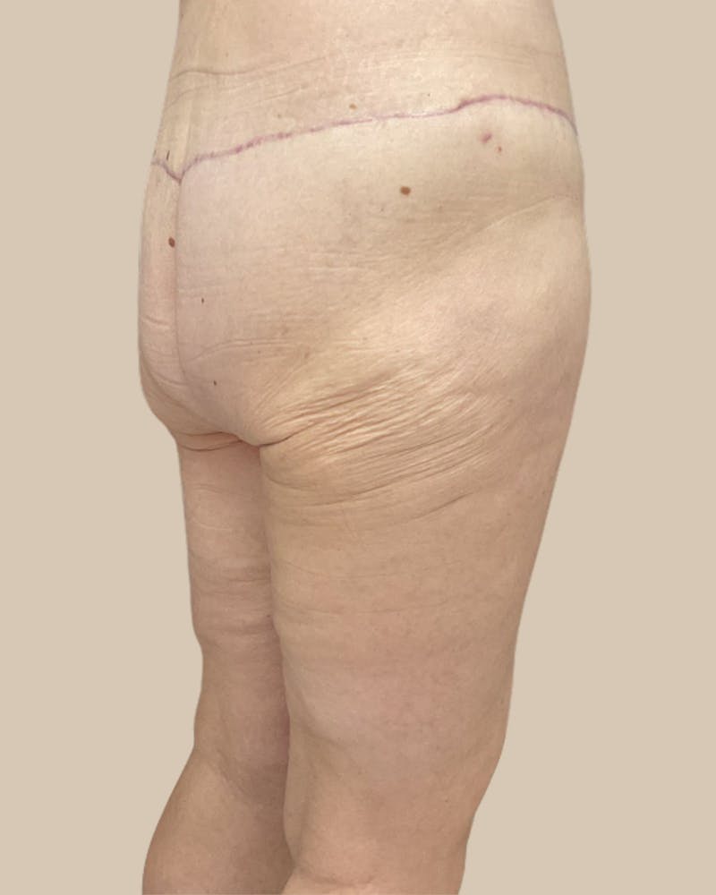 Liposuction Before & After Gallery - Patient 410516 - Image 4