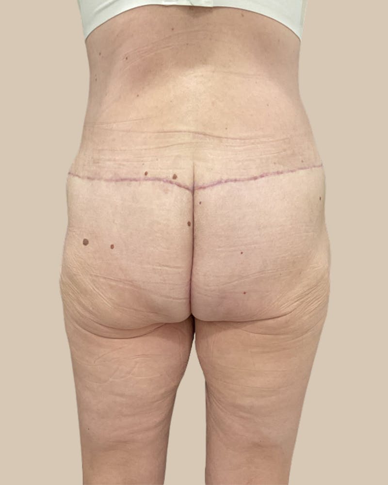Liposuction Before & After Gallery - Patient 410516 - Image 6