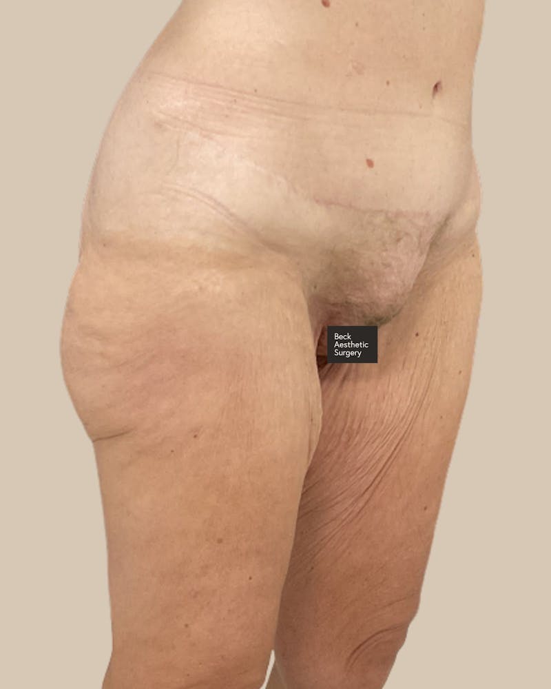 Liposuction Before & After Gallery - Patient 410516 - Image 7