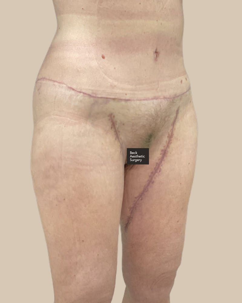 Liposuction Before & After Gallery - Patient 410516 - Image 8