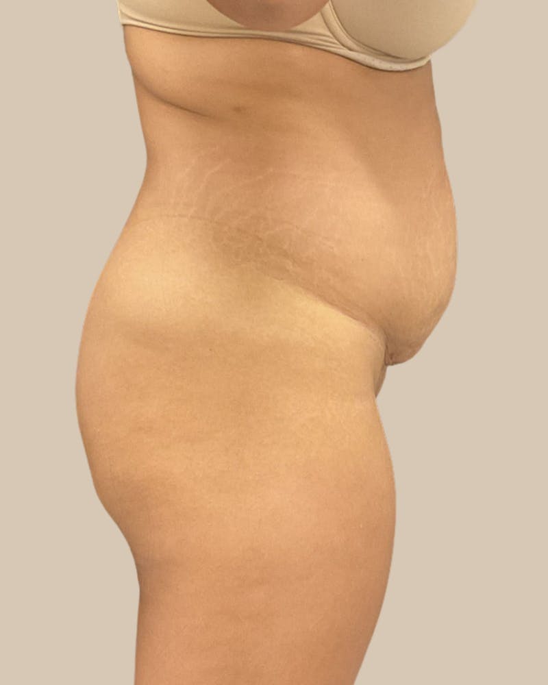 Liposuction Before & After Gallery - Patient 372314 - Image 11
