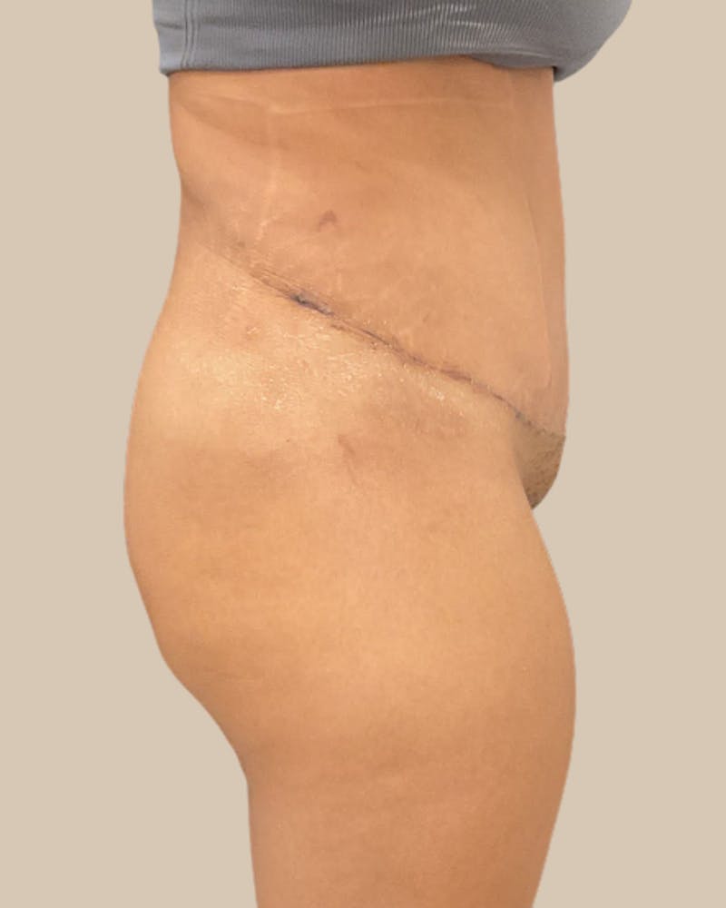 Liposuction Before & After Gallery - Patient 372314 - Image 12