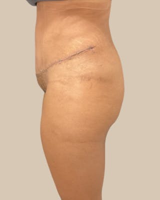 Liposuction Before & After Gallery - Patient 372314 - Image 6