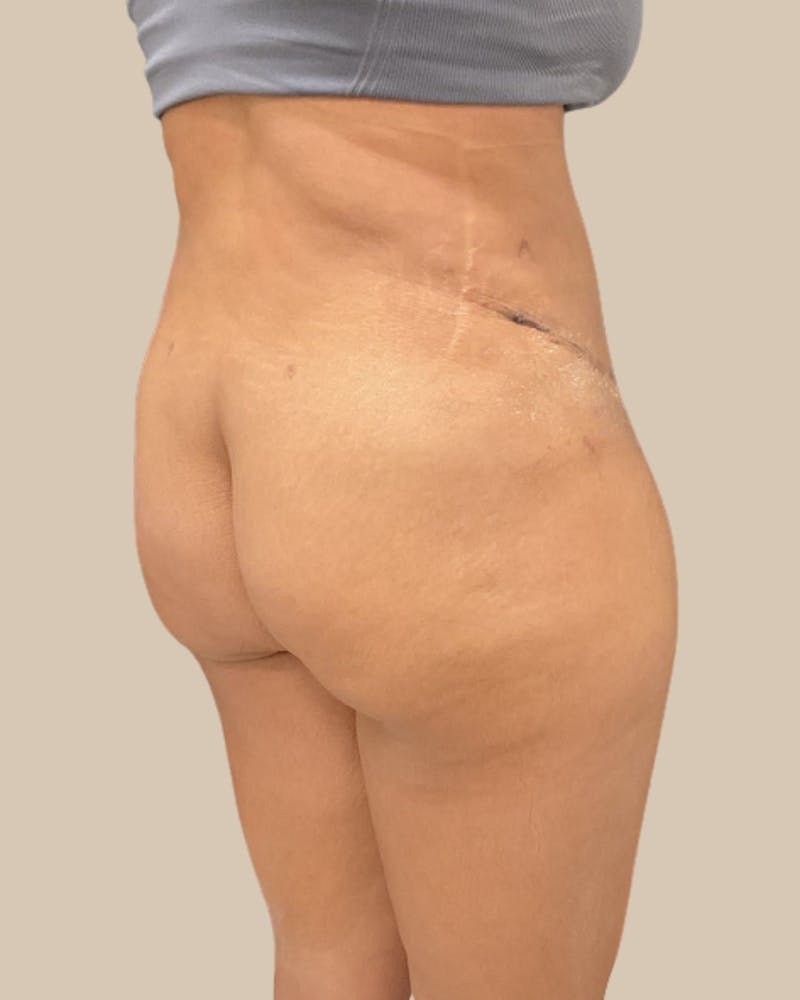 Liposuction Before & After Gallery - Patient 372314 - Image 10
