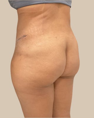 Liposuction Before & After Gallery - Patient 372314 - Image 8