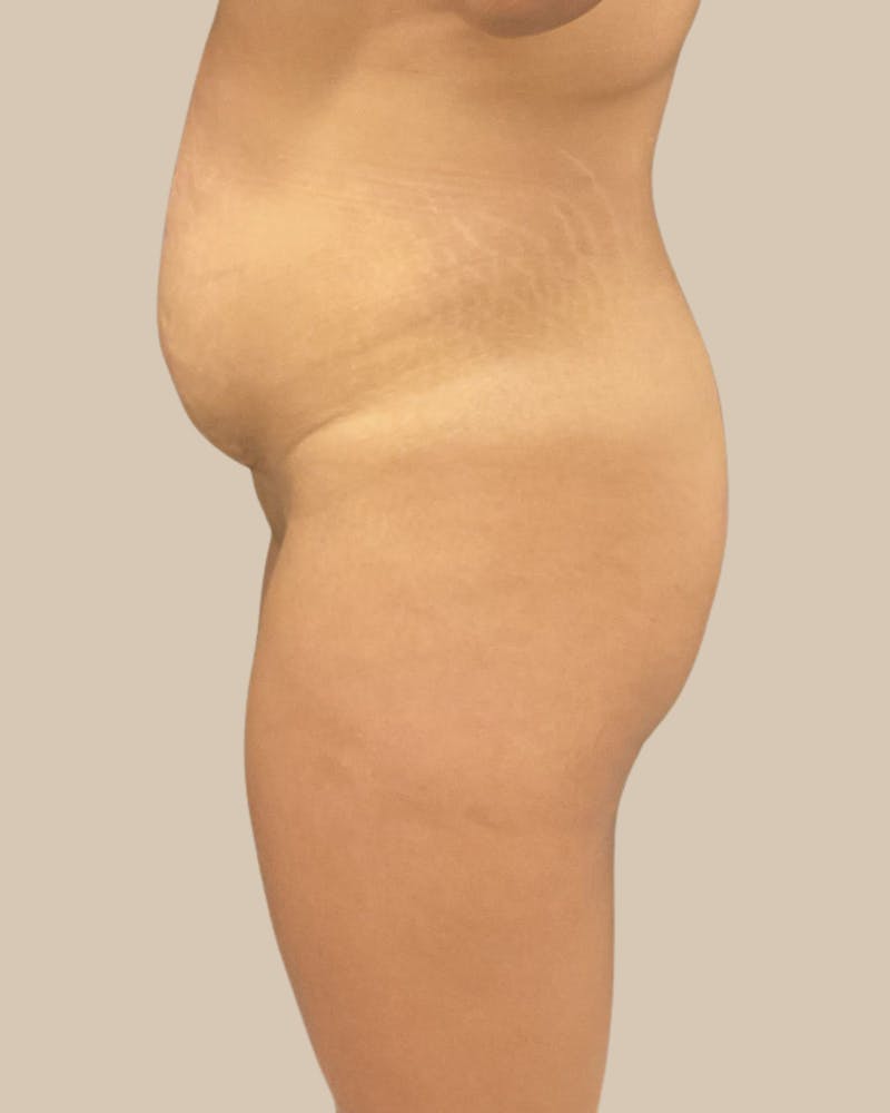 Liposuction Before & After Gallery - Patient 372314 - Image 5