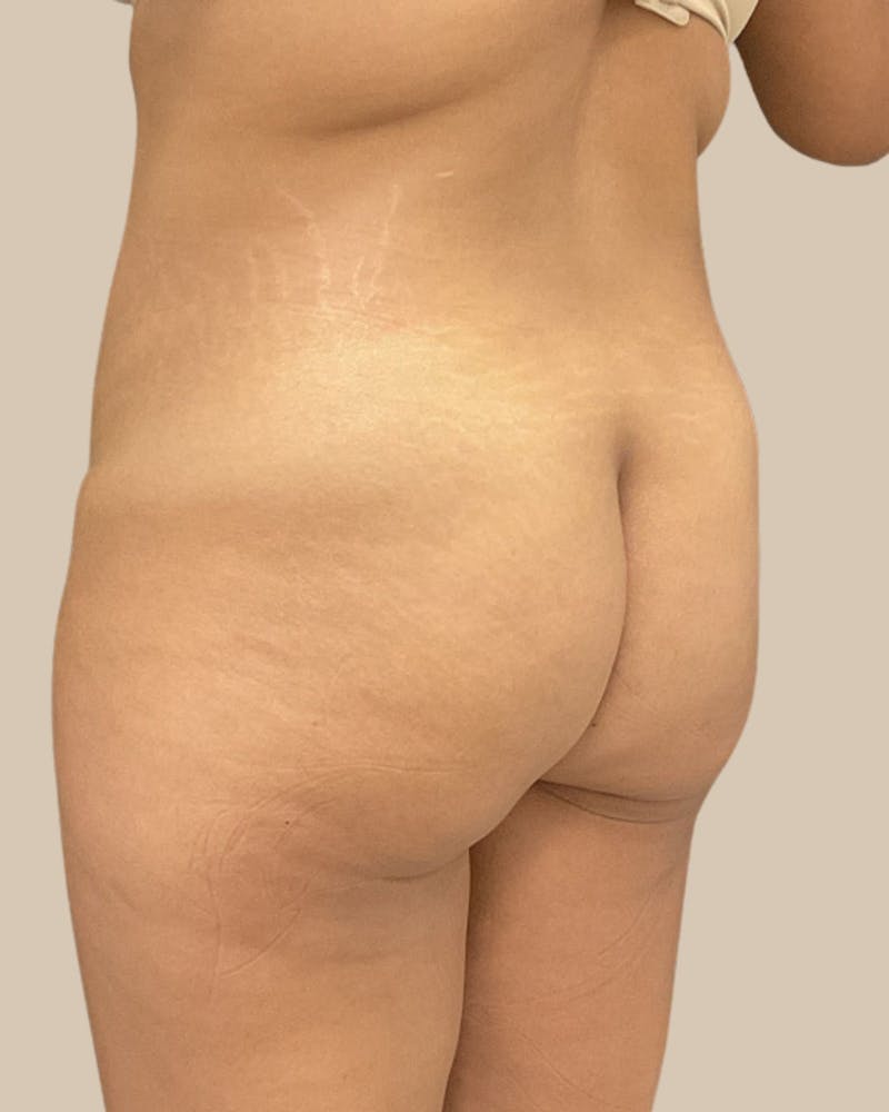 Liposuction Before & After Gallery - Patient 372314 - Image 7